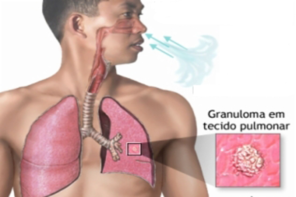 Estação do Eldorado recebe ação de combate à Tuberculose