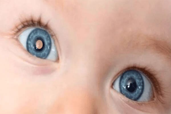 GRAACC faz campanha para alertar sobre o retinoblastoma