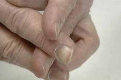 Dedos masculinos podem indicar risco de câncer