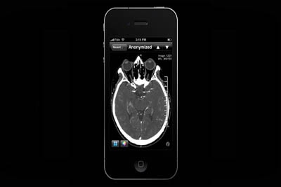 Aplicativo para iphone pode diagnosticar derrames cerebrais