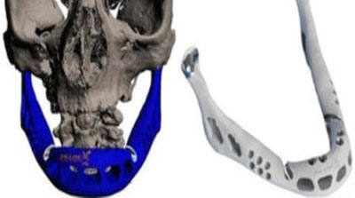 Mulher recebe prótese de mandíbula fabricada por impressora 3D