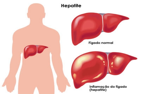 Hepatite C: A doença silenciosa