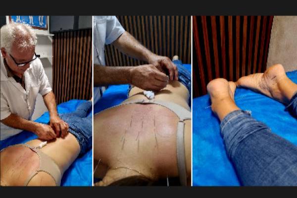  Governo Federal regulamenta a acupuntura e reconhece a profissão